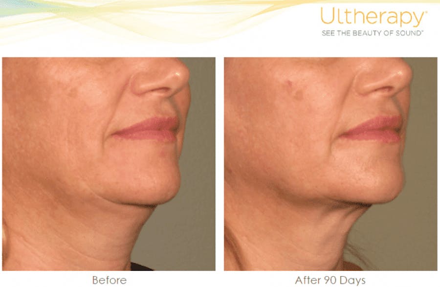 under chin before and afters