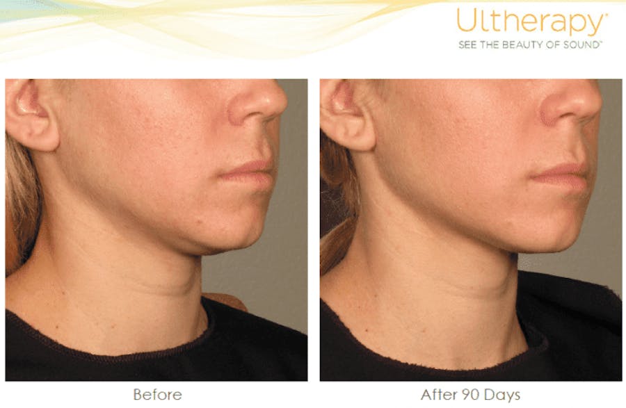 under chin before and afters