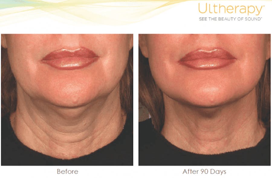 under chin before and afters