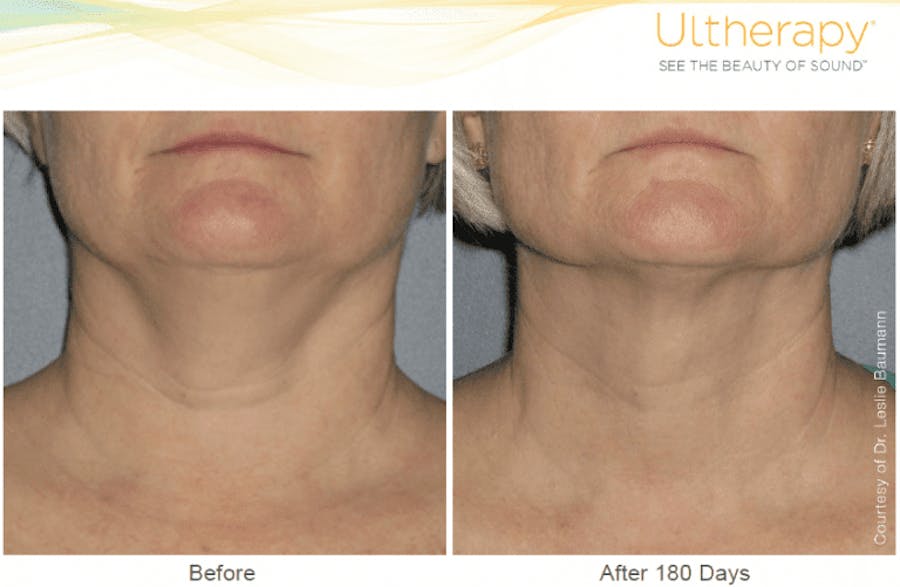 under chin before and afters
