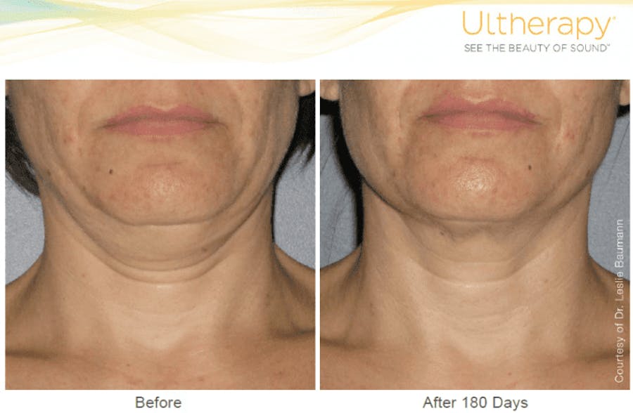 neck before and afters