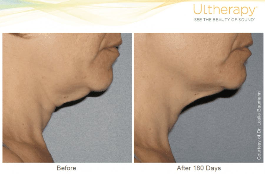 neck before and afters