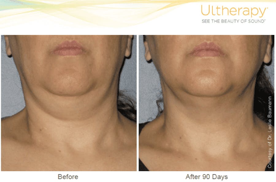 neck before and afters