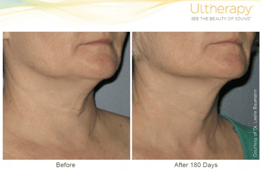 neck before and afters
