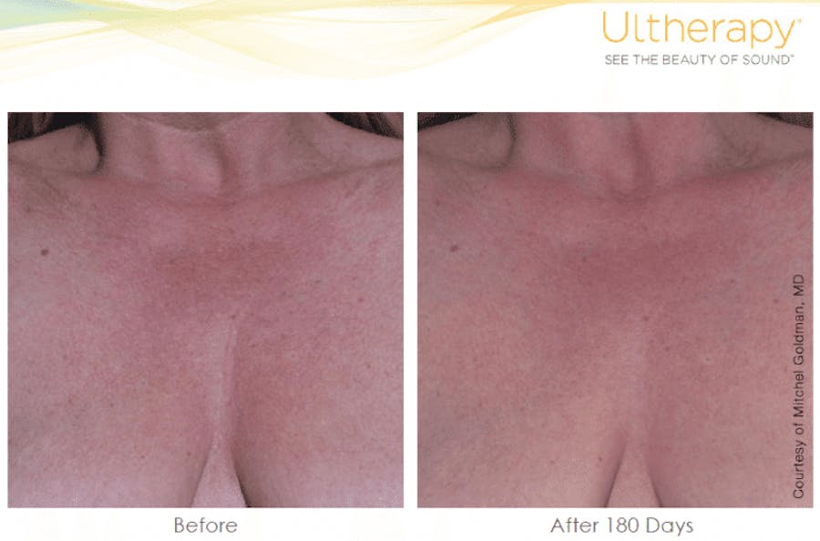 chest before and afters