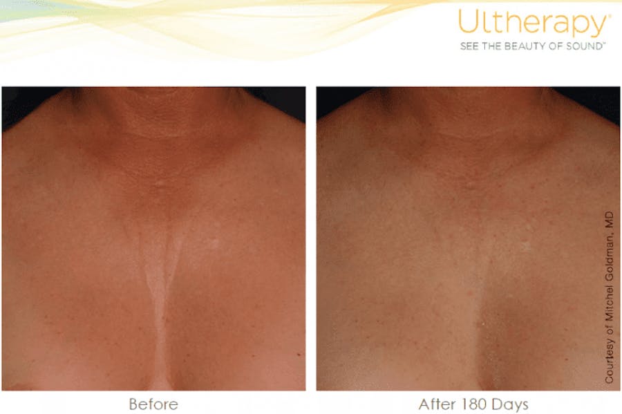 chest before and afters