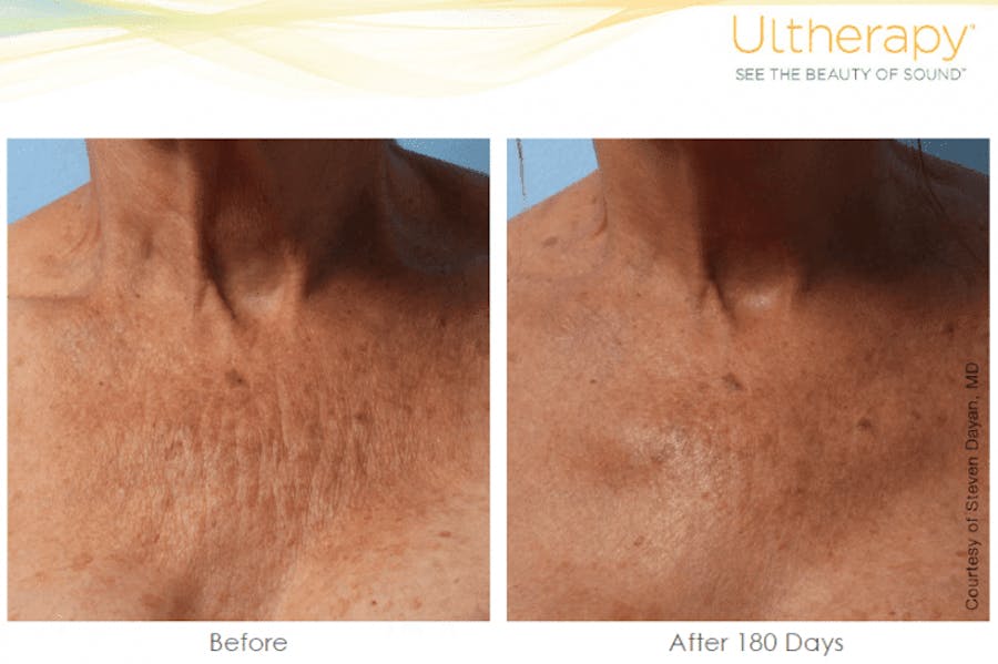 chest before and afters