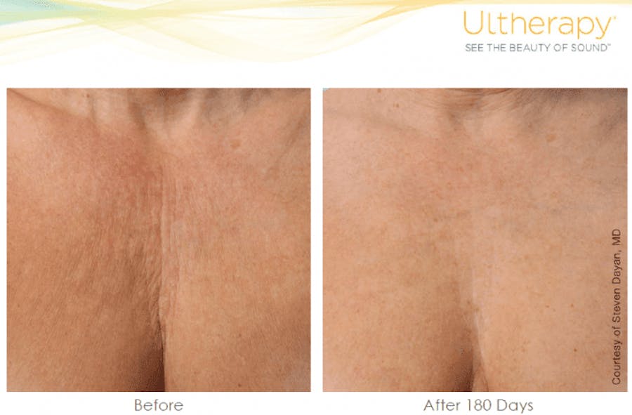 chest before and afters