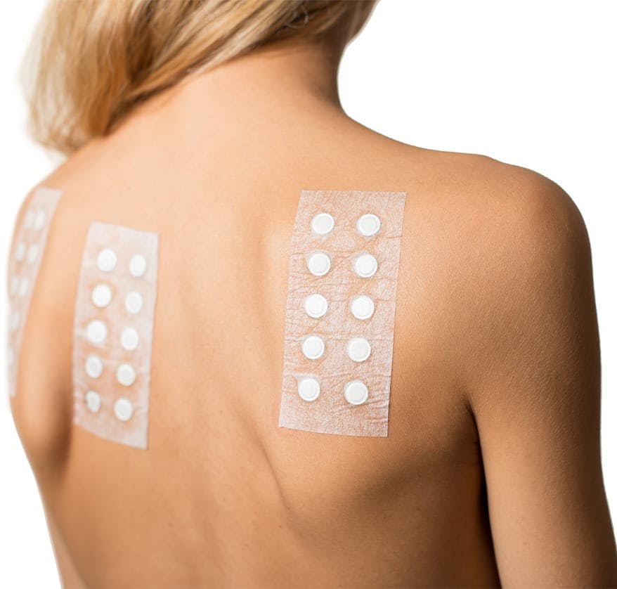 Woman with allergy patches on her back