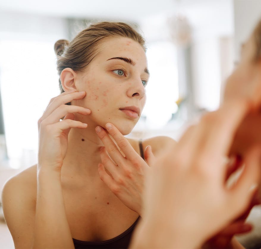 Woman looking at acne on cheek