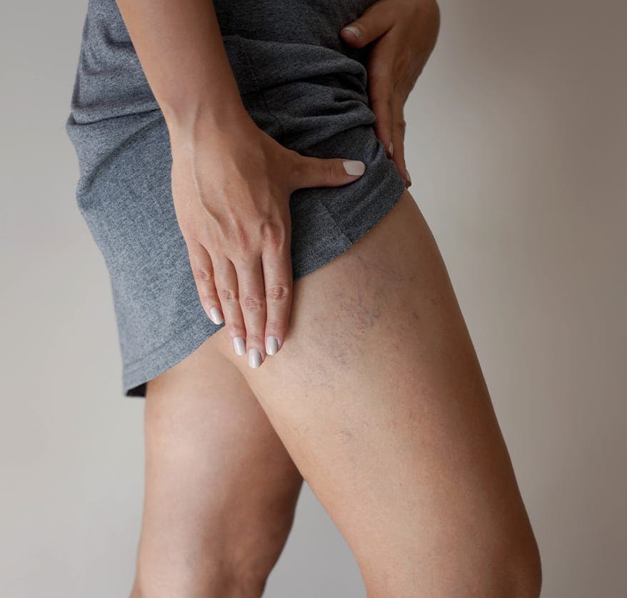 Varicose veins on woman's thigh