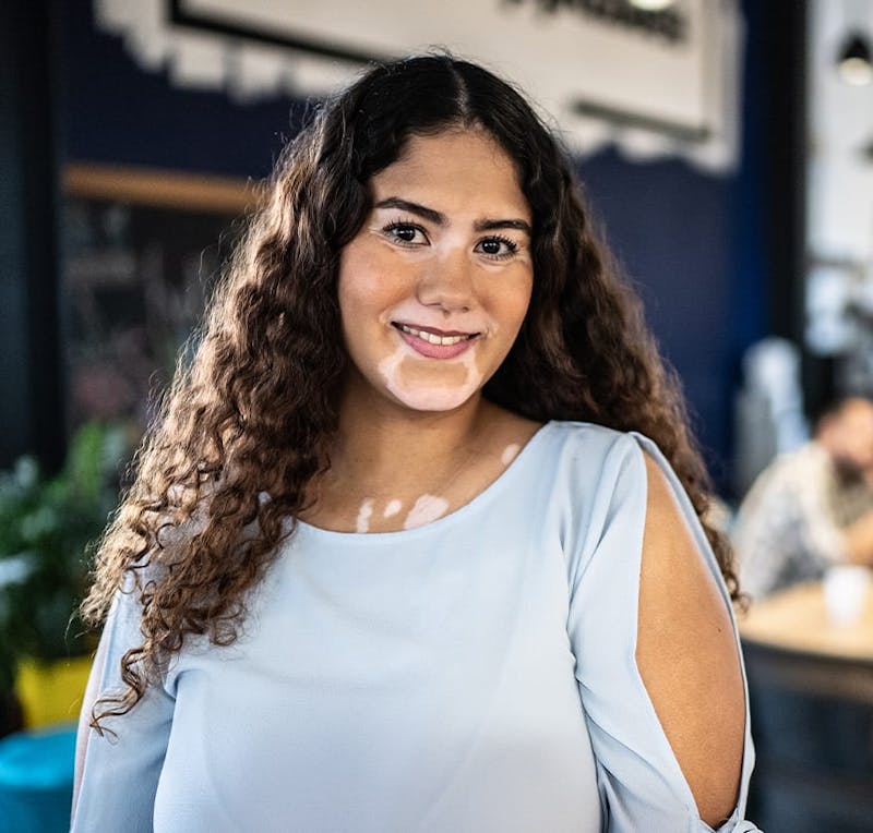 Smiling woman with vitiligo