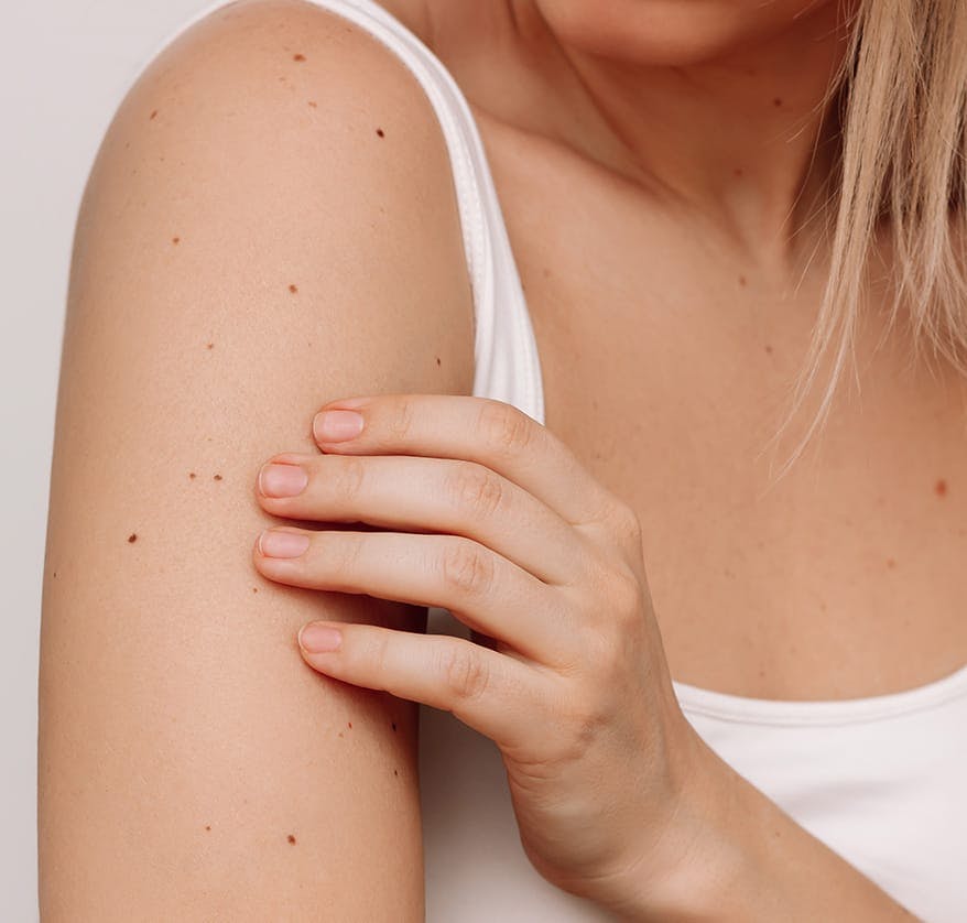 Woman's shoulder with moles