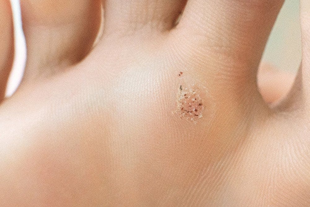 Seed Warts - Symptoms | APDerm