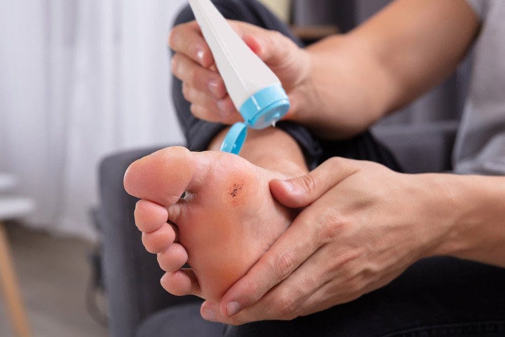 Seed Warts Treatments | APDerm