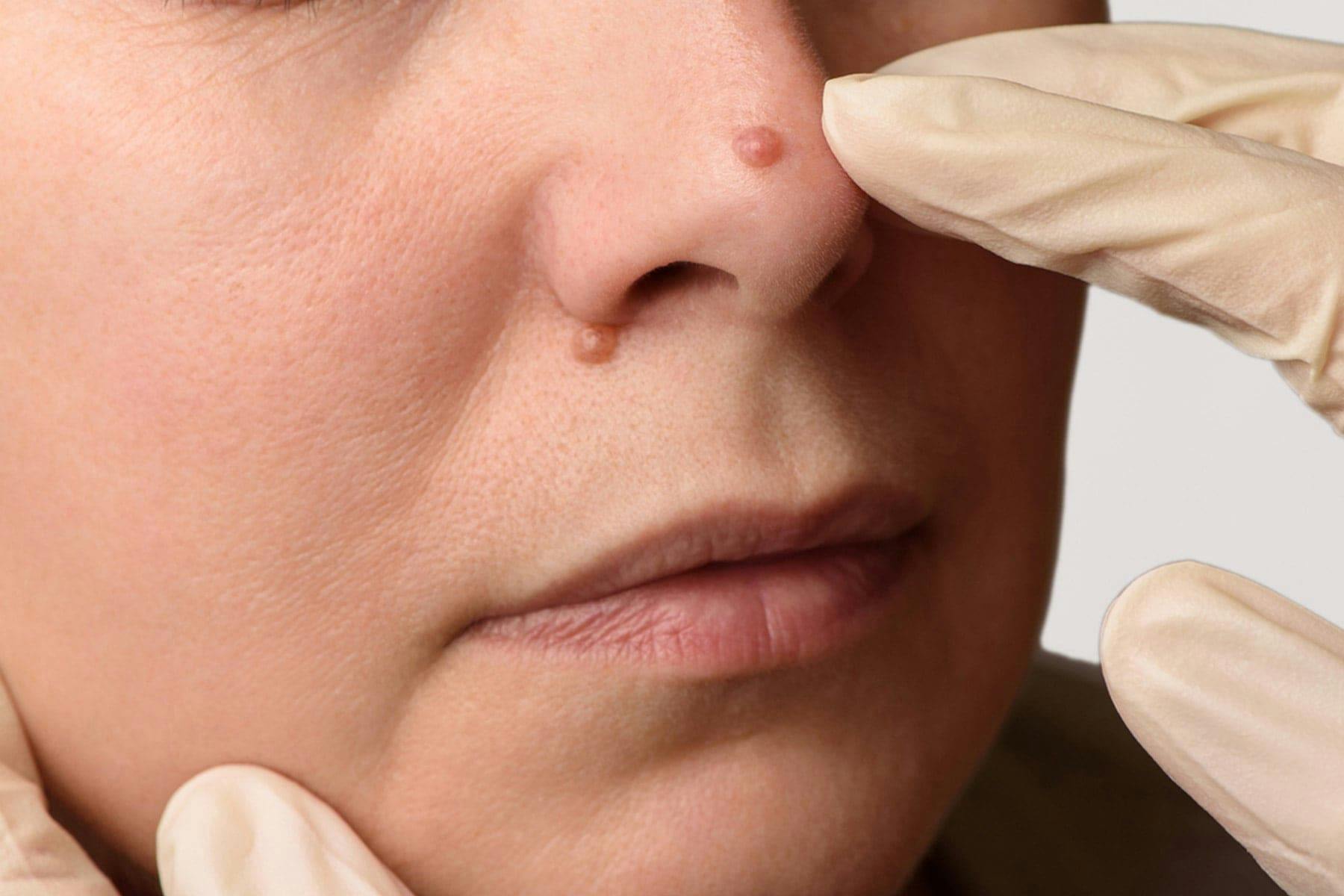 Flat Warts | APDerm