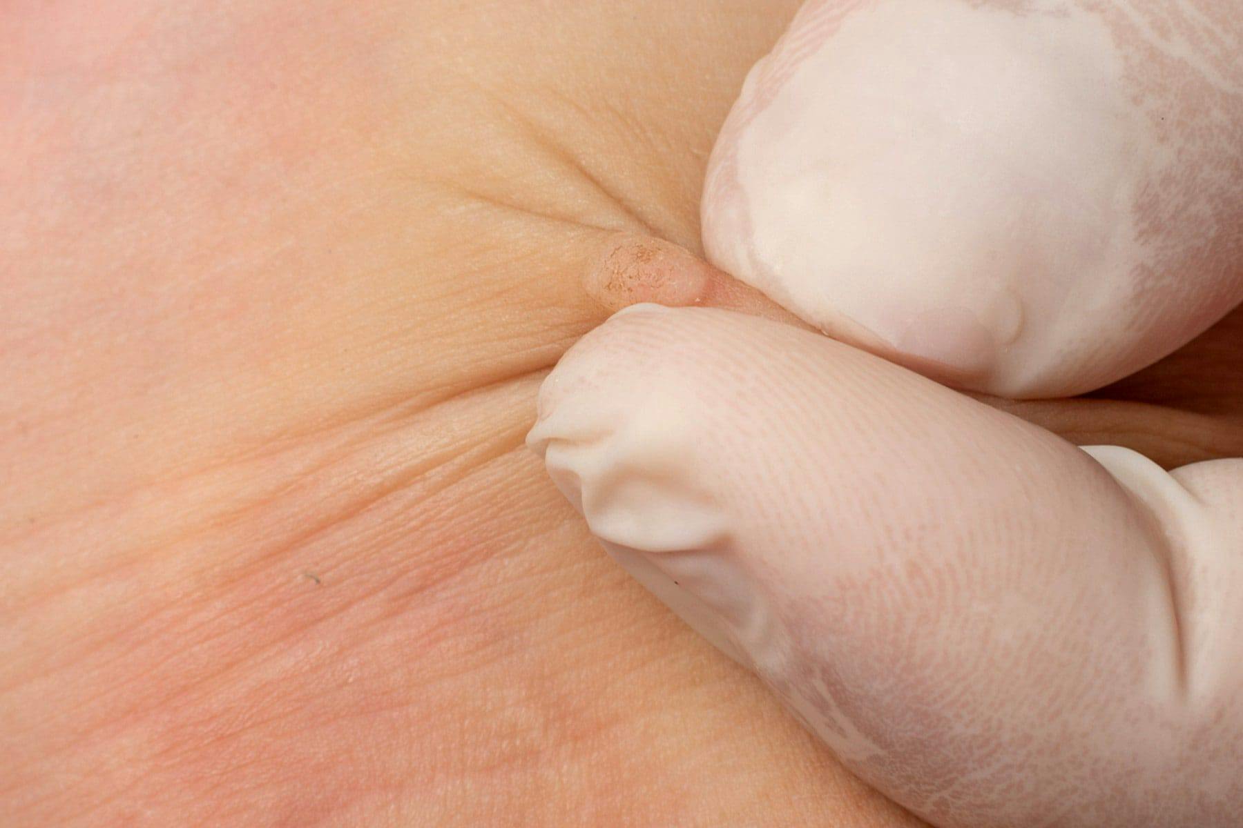 Flat Warts - APDerm