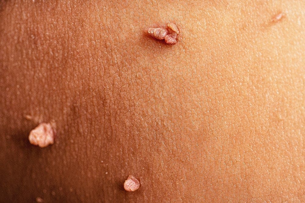 Celebrities With Genital Warts 60 Photos Moonagedaydream film Celebrities With Genital Warts 60 Photos Moonagedaydream film