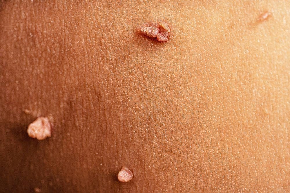 Genital Warts Everything You Need To Know APDerm Genital Warts Everything You Need To Know APDerm