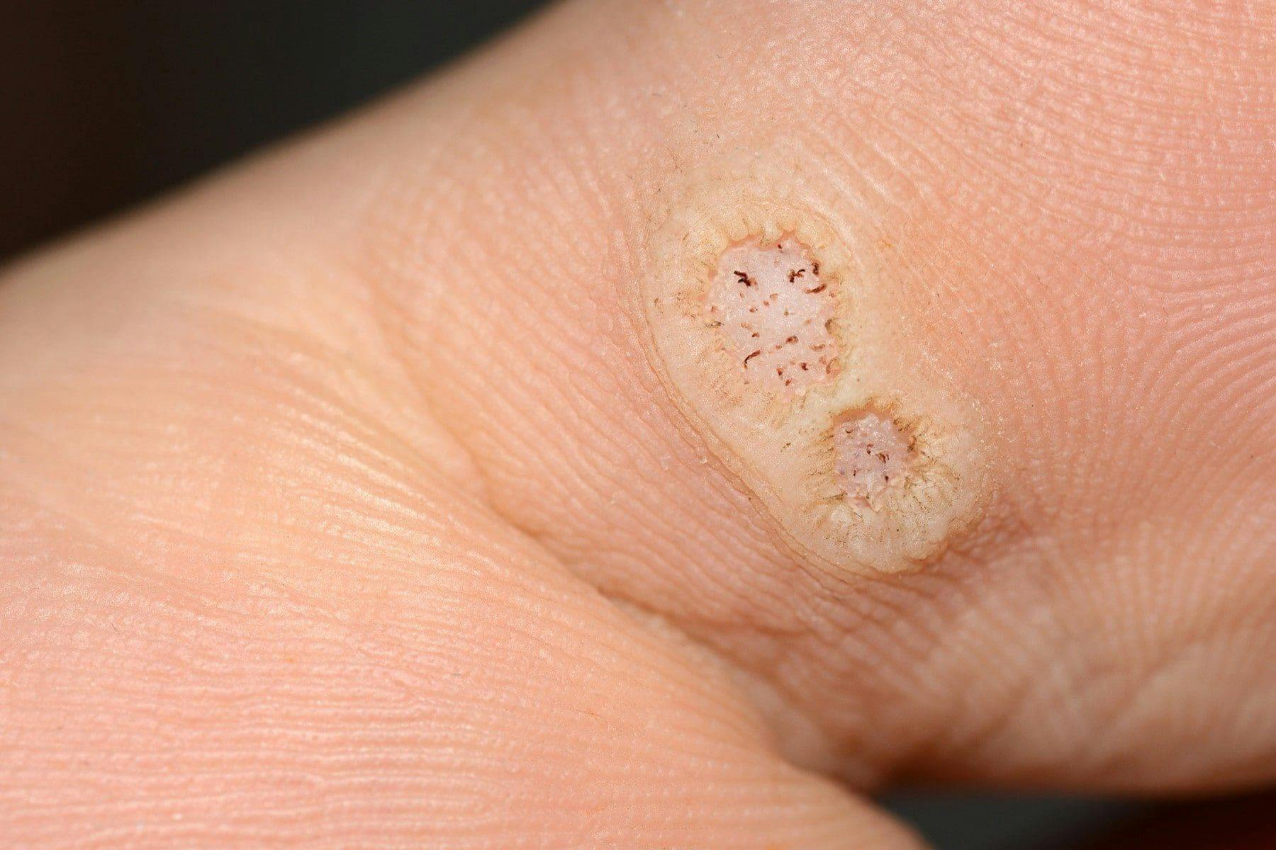 Planter Warts - Everything You Need To Know | APDerm