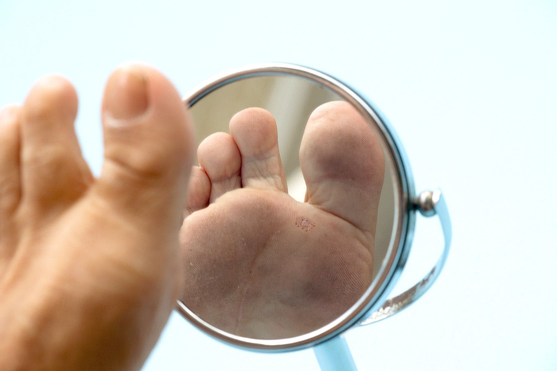 Planter Warts - Everything You Need To Know | APDerm
