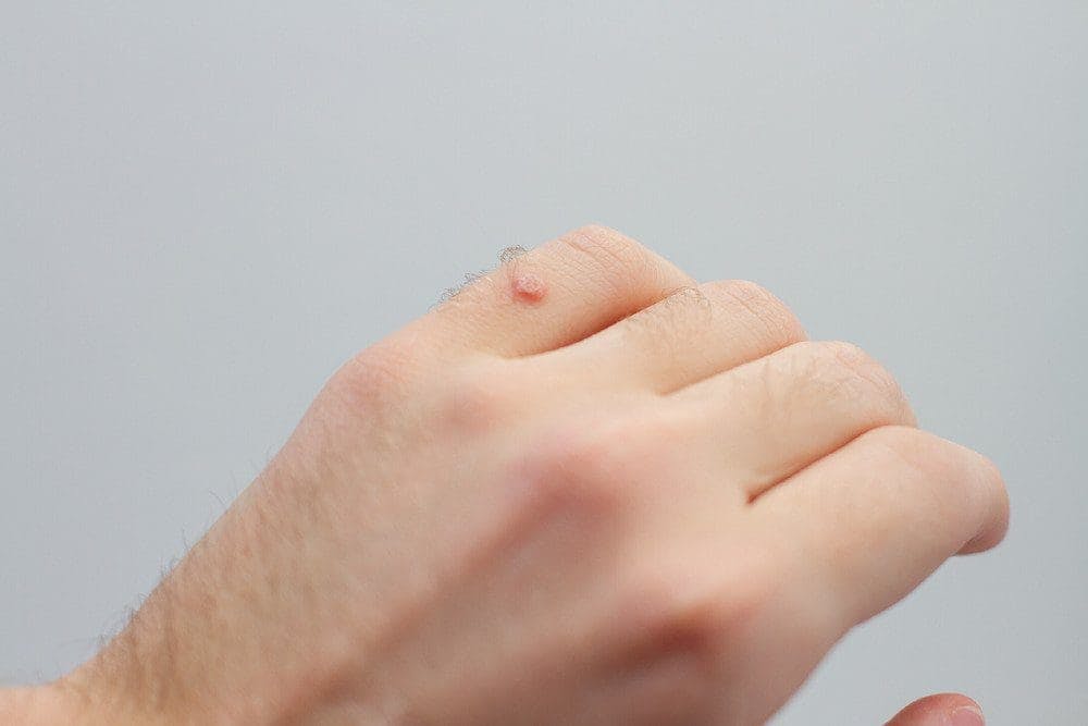 Type of Warts - APDerm