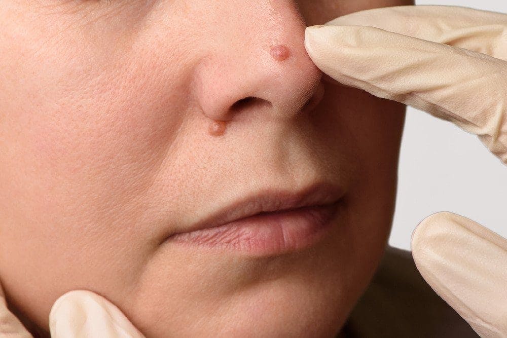 Type of Warts - APDerm