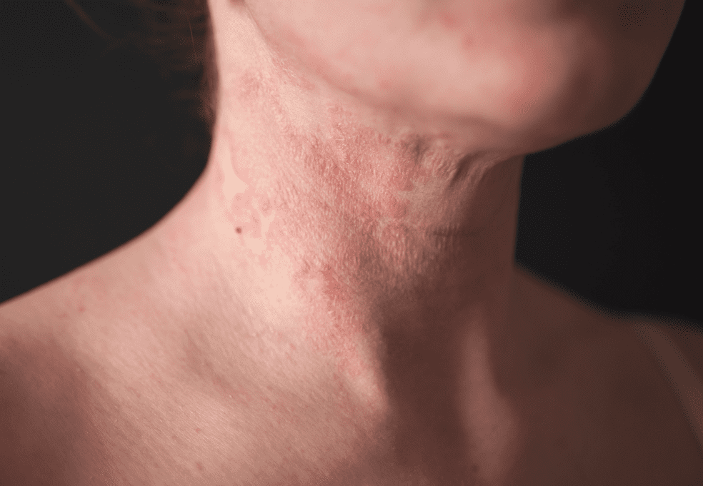 Eczema