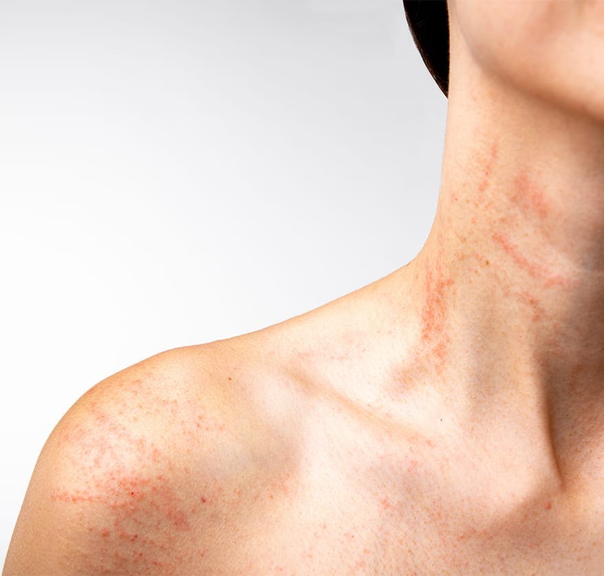 Woman touching hives on cheek