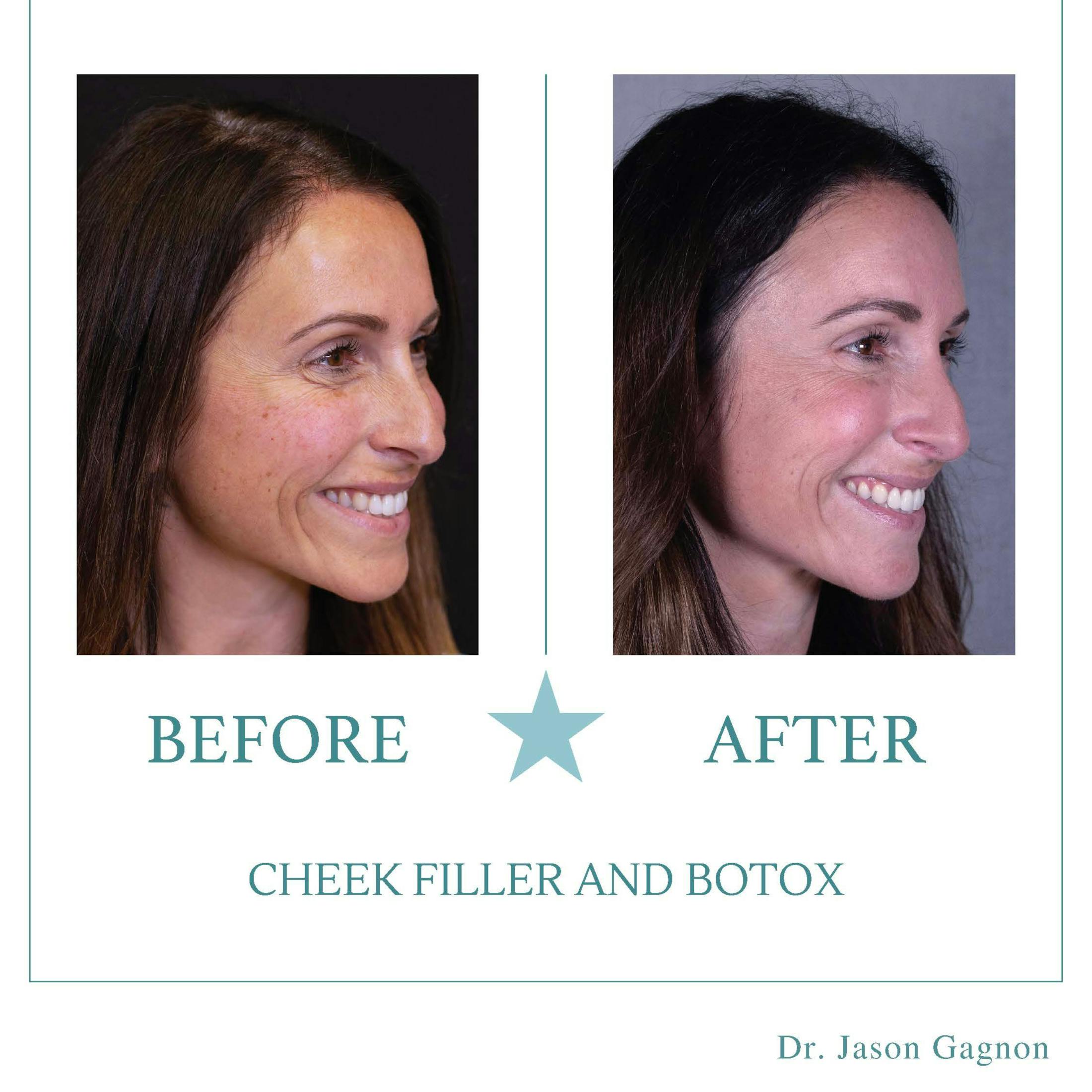 filler and Botox before and after