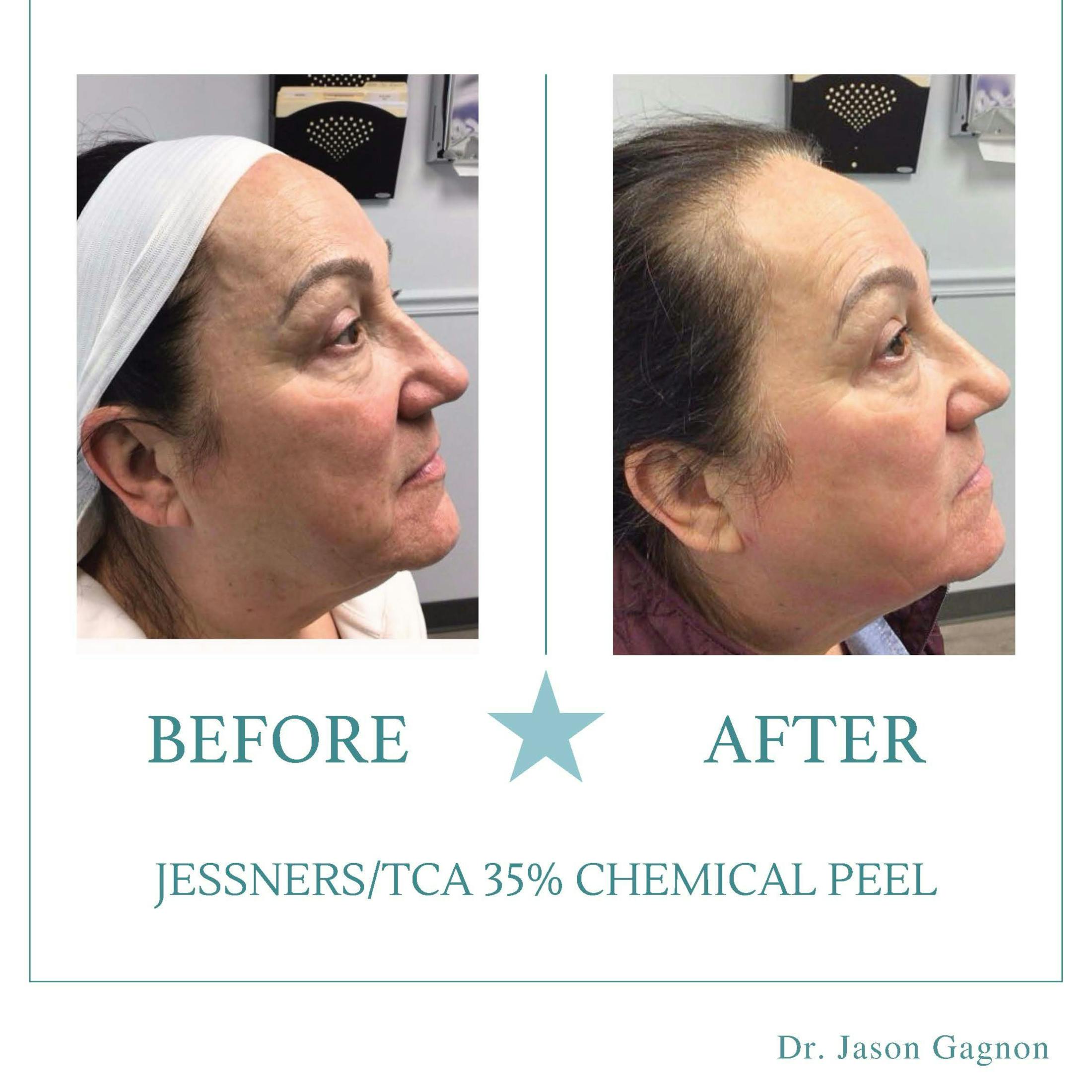 chemical peel before and after