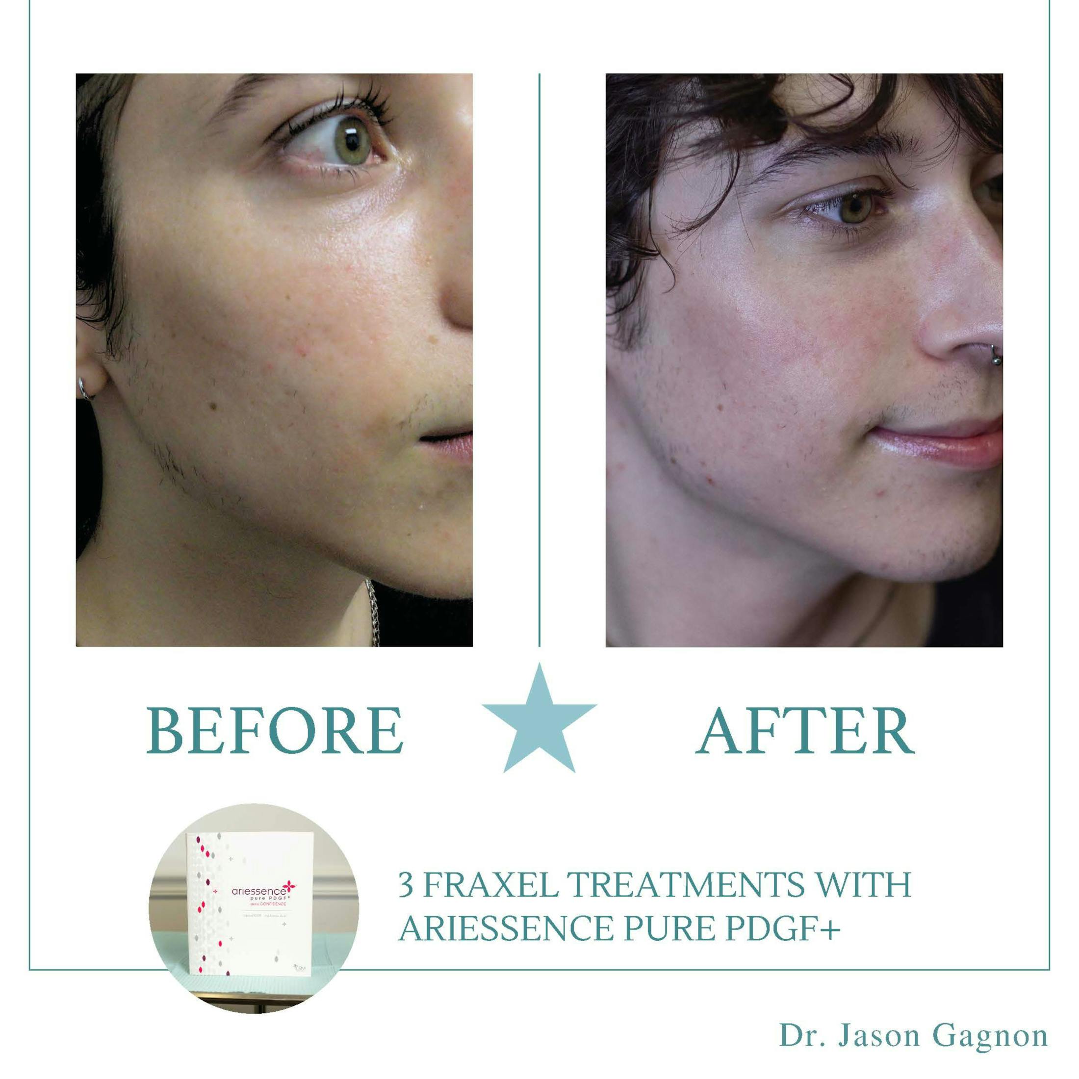 Fraxel before and after