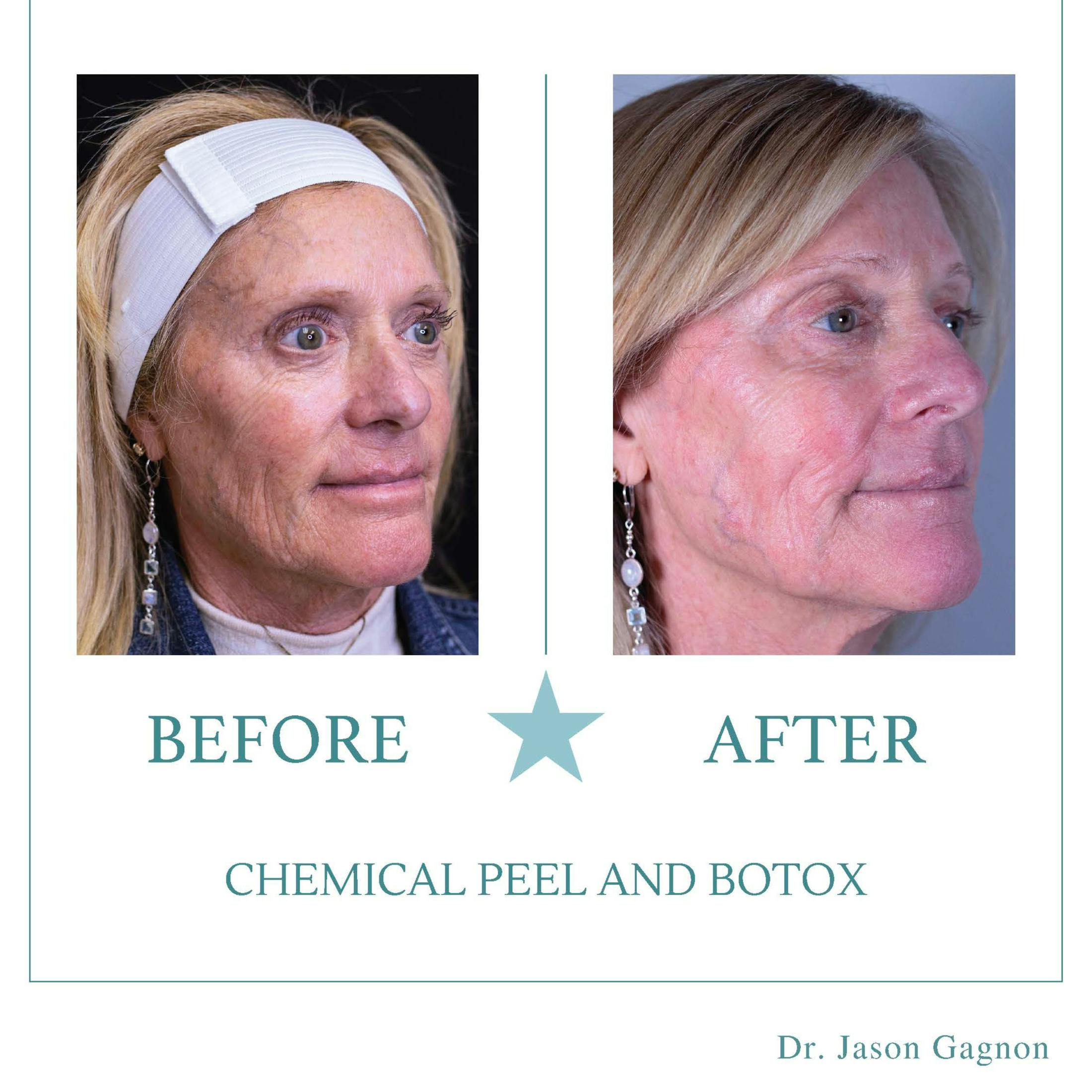 peel andf Botox before and after