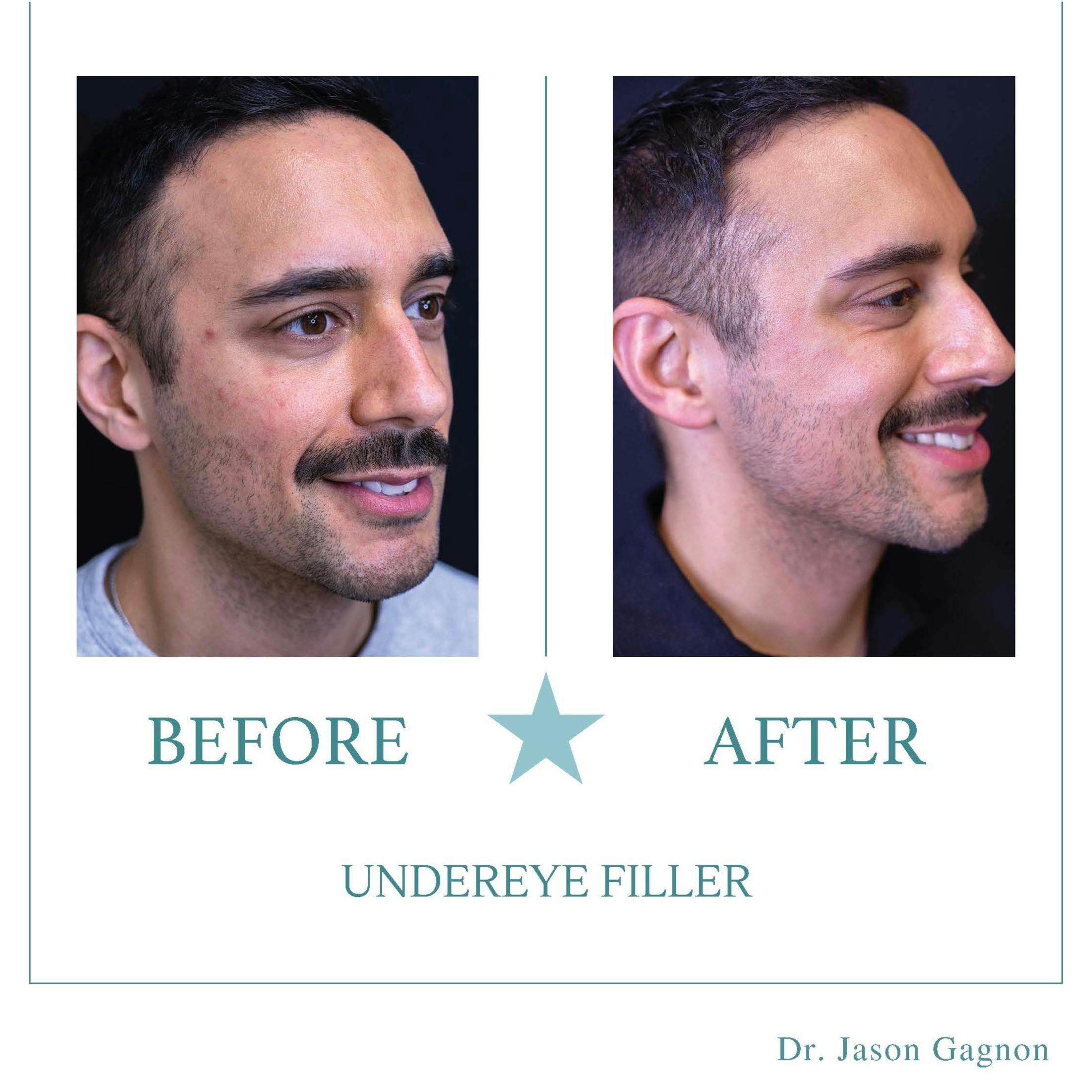 undereye filler before and after