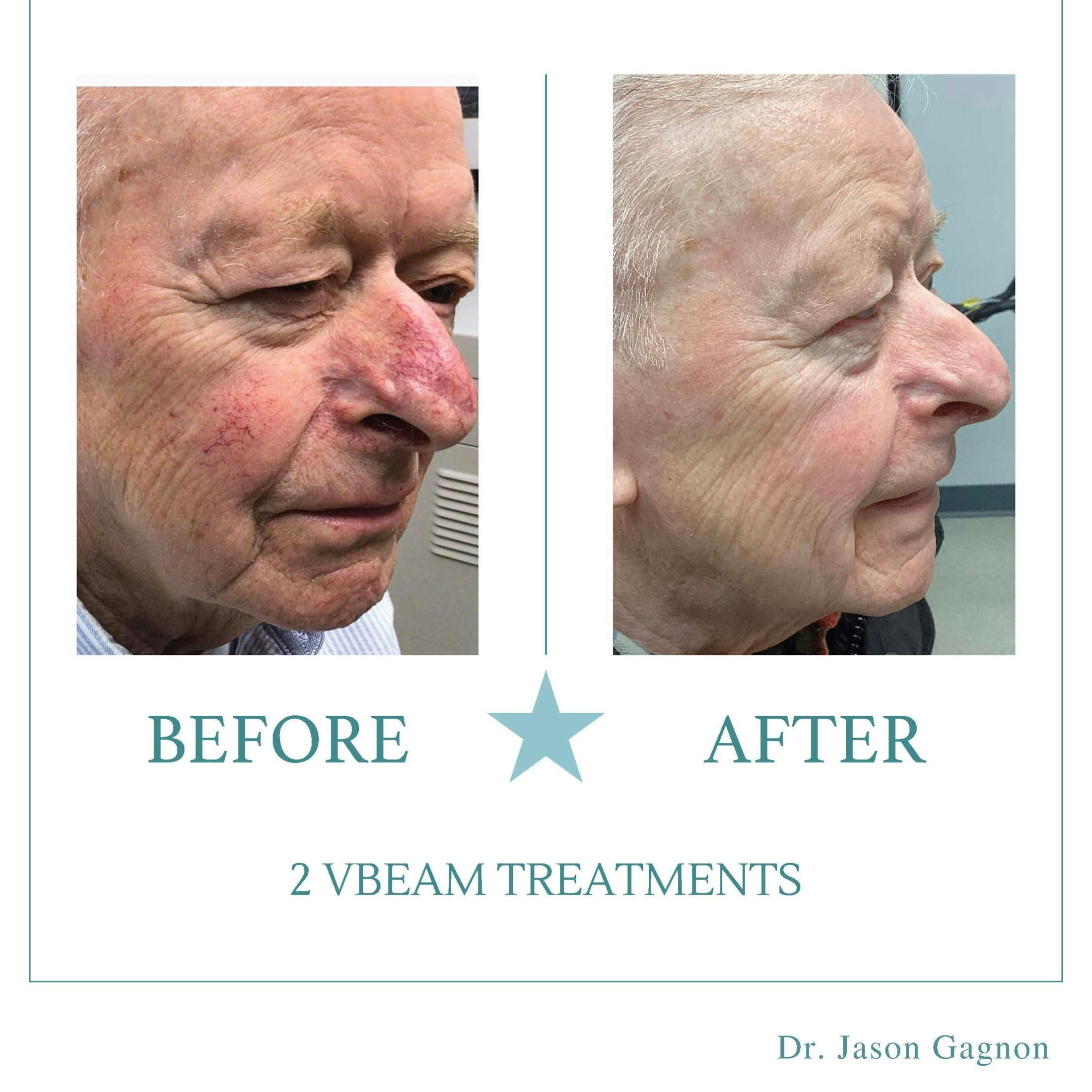 vbeam before and after