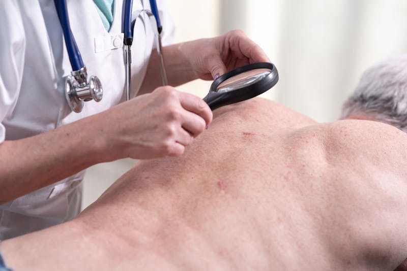 Doctor inspecting man's back for signs of skin cancer
