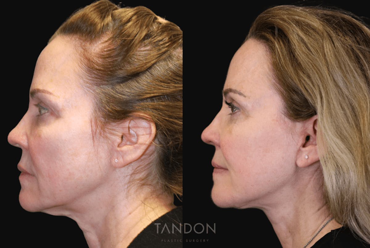 Facelift Before & After Gallery - Patient 316841 - Image 5