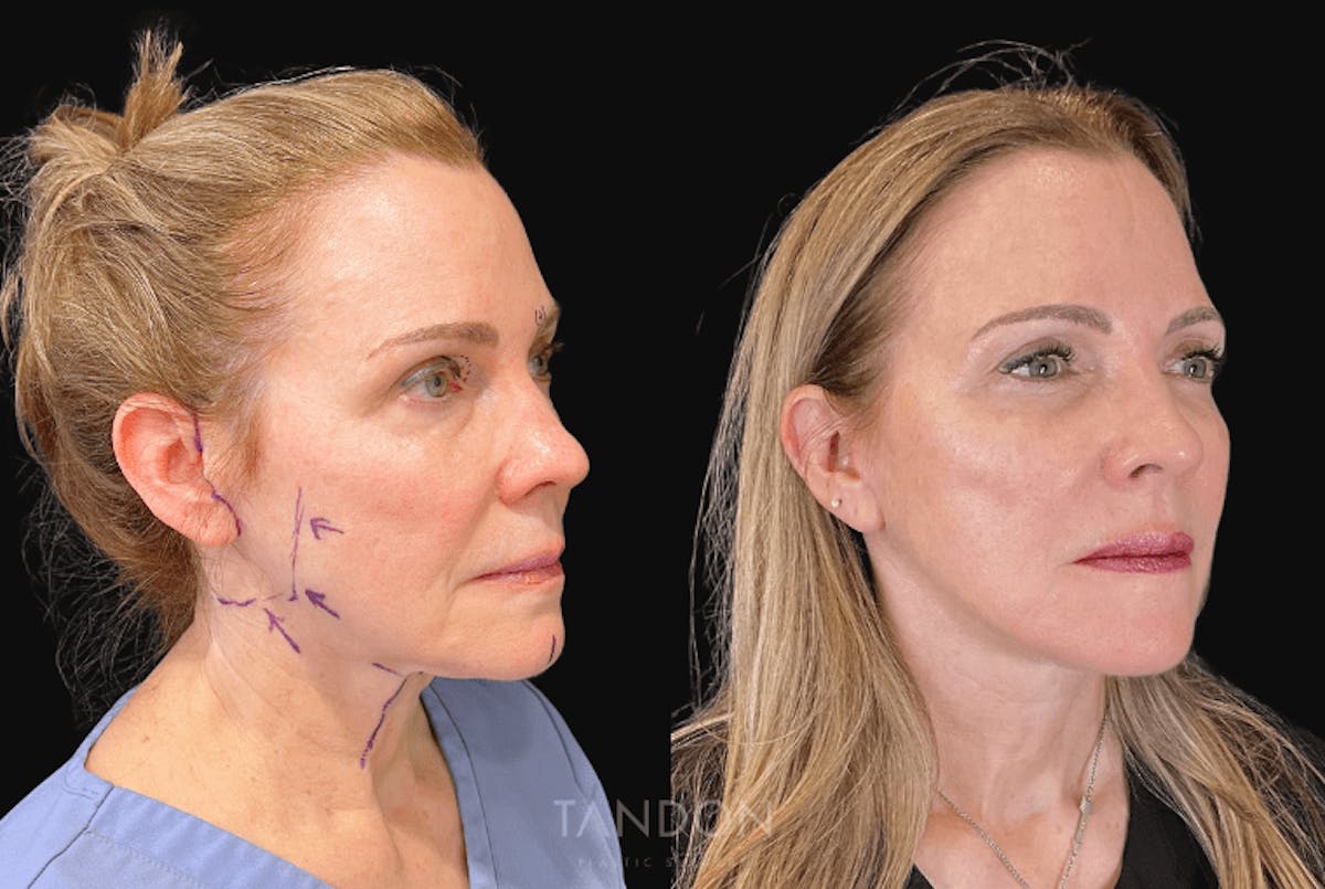 Facelift Before & After Gallery - Patient 316841 - Image 3