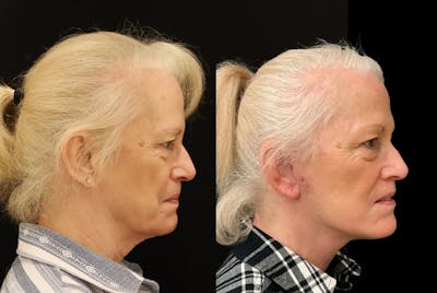 Facelift Before & After Gallery - Patient 554313 - Image 1