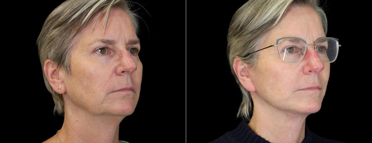 Facelift Before & After Gallery - Patient 275688 - Image 4