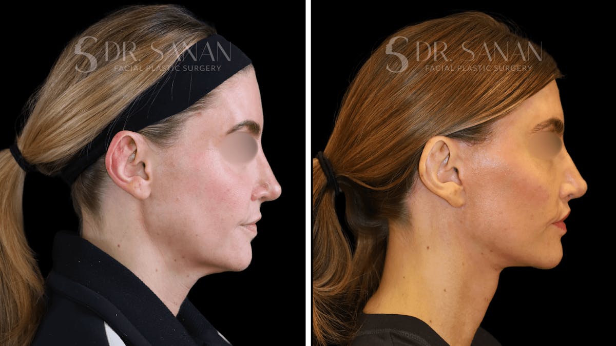 Deep Plane Facelift Before & After Gallery - Patient 163665 - Image 2