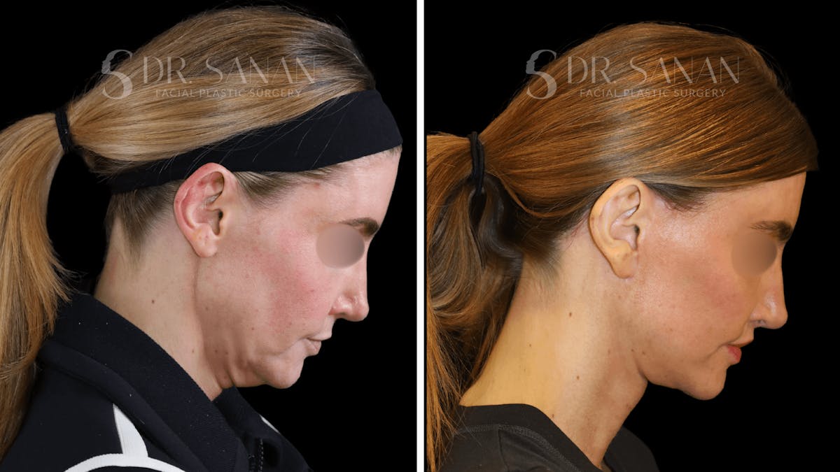 Deep Plane Facelift Before & After Gallery - Patient 163665 - Image 7