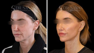 Sanan-Deep Plane Facelift Before & After Gallery - Patient 104289 - Image 1