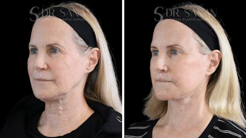 Before and after photos with Akshay Sanan, MD, FACS - patient 3 of 4