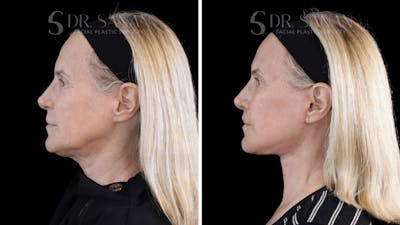 Deep Plane Facelift Before & After Gallery - Patient 273063 - Image 1