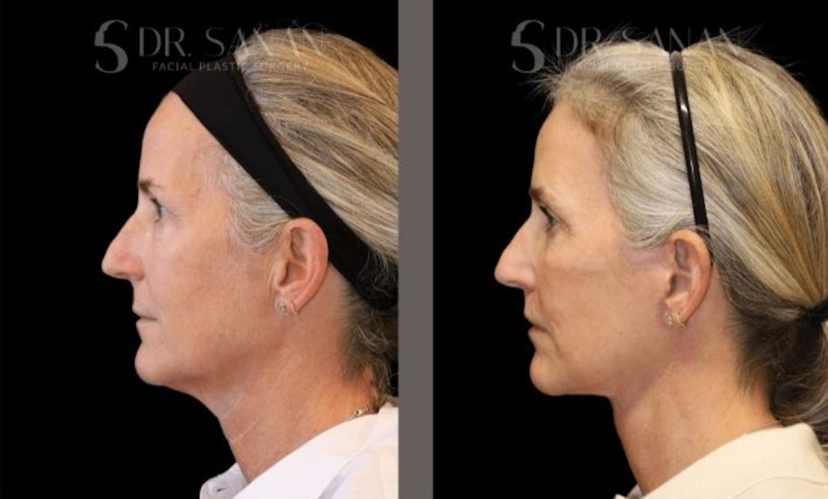 Deep Plane Facelift Before & After Gallery - Patient 155305 - Image 1