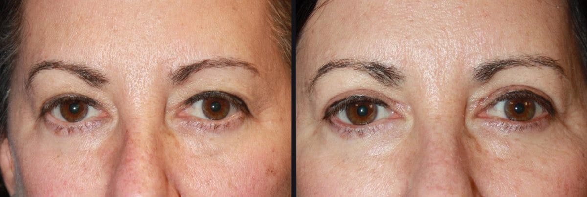 Blepharoplasty Before & After Gallery - Patient 176332 - Image 1