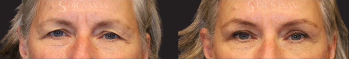 Blepharoplasty Before & After Gallery - Patient 918734 - Image 1