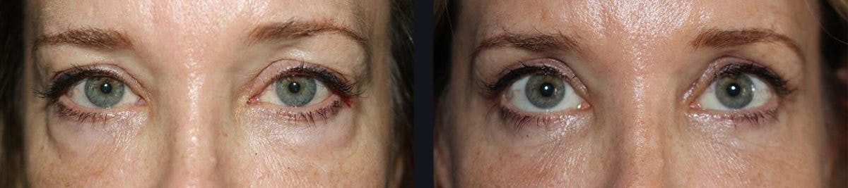 Blepharoplasty Before & After Gallery - Patient 422650 - Image 1