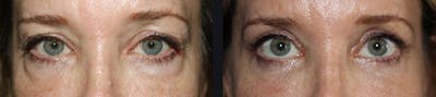 Blepharoplasty Before & After Gallery - Patient 422650 - Image 1